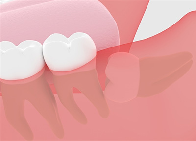 親知らずが生えてきた！抜かなきゃダメ？