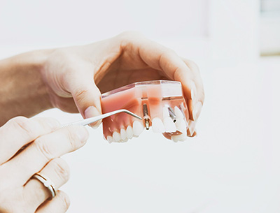 インプラントって実際どうなの？